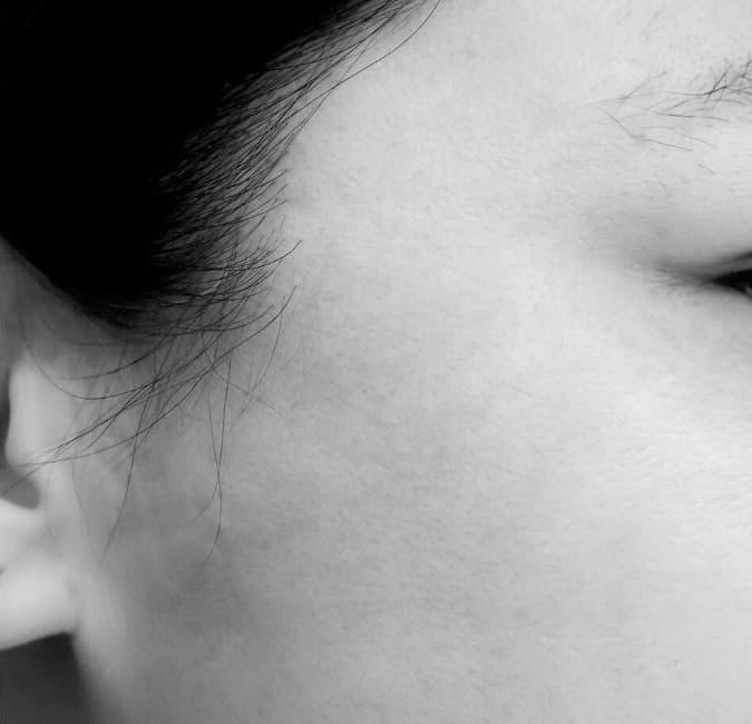 Before photo of Luminesce Patient in Pasadena, CA