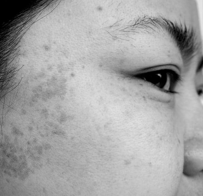 Before photo of Luminesce Patient in Pasadena, CA