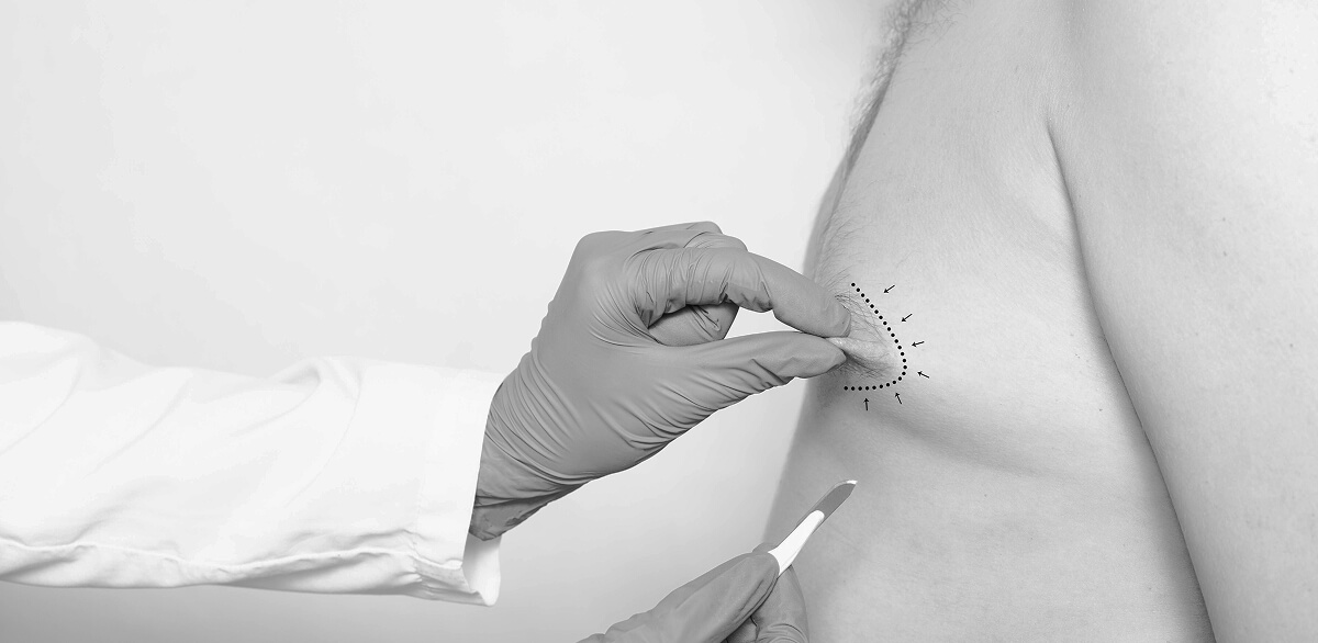 Does Gynecomastia Come Back After Surgery​?