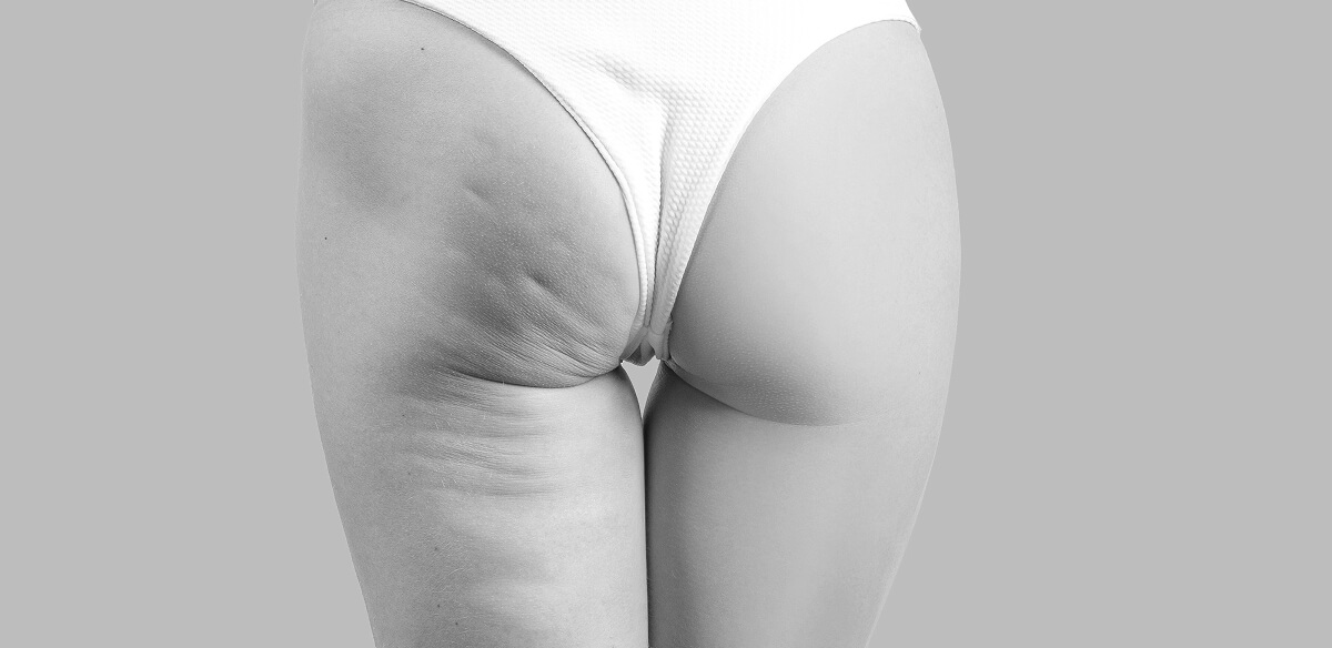 Does Collagen Work for Cellulite? Here’s What You Should Know